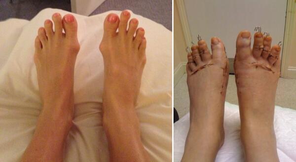 Операция Пепеляшка: Бихте ли причинили това на краката си?
