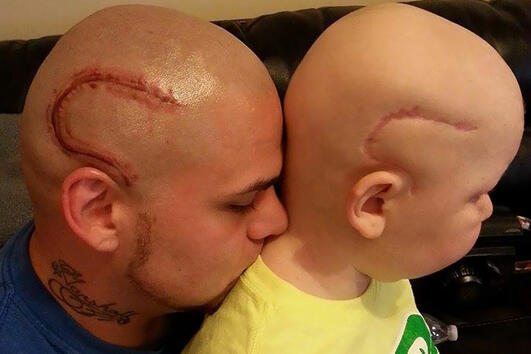 Баща си татуира същия белег на главата като този на сина си в знак на подкрепа