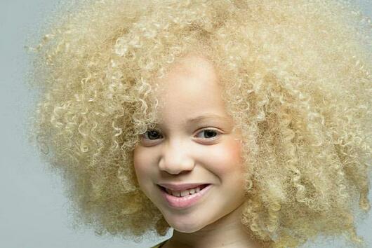 Момиченце афроамериканка-албинос е новата звезда в модния свят
