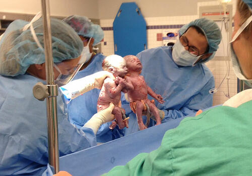 Близначки се раждат хванати за ръце и все още са неразделни