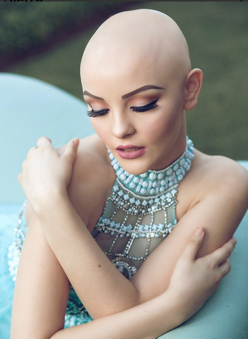 Вдъхновяваща фотосесия на едно болно момиче от рак без перуката й