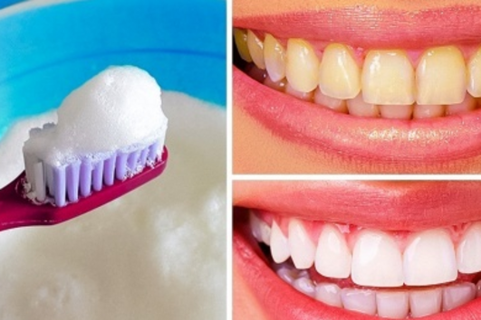 9-те най-добри начина за естествено избелване на зъбите 