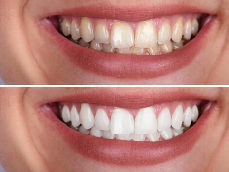 Предимства и недосатъци на избелването на зъби