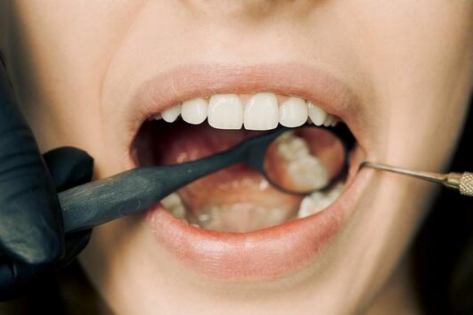 5 навика, които развалят зъбите ни