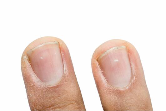 Бели петна по ноктите: Какво означават?