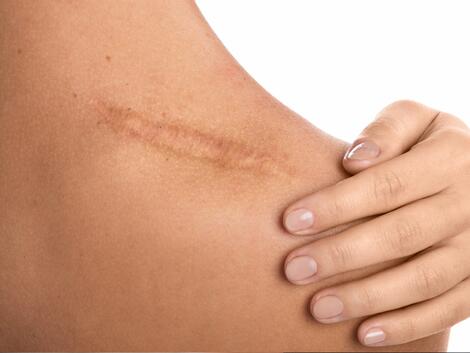 5 начина за отстраняване на белези по кожата